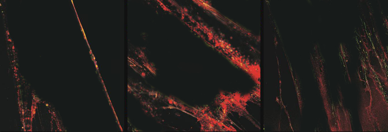 Fibroblasts before treatment